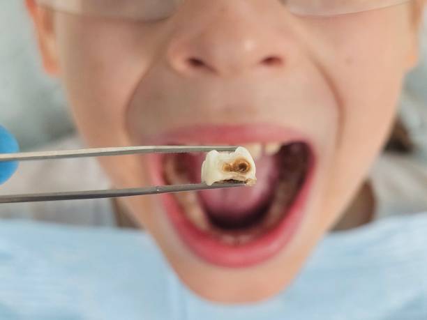 Best Emergency Tooth Extraction in Vienna, WV